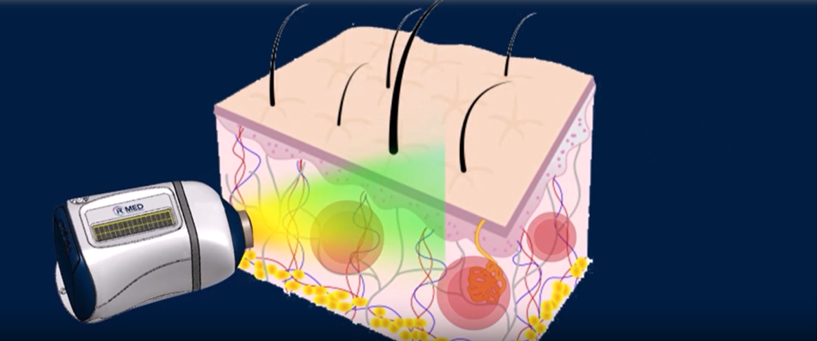 PressureSafe - IR MEDICAL